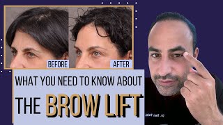 What You Need To Know About The Brow Lift  Dr Ben Talei Beverly Hills Los Angeles [upl. by Yentruoc]