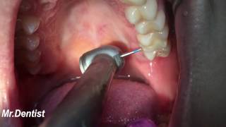 Tooth Cavity Filling [upl. by Reddin]