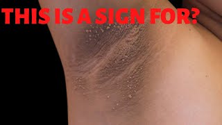 ACANTHOSIS NIGRICANS What causes Acanthosis nigricans Acanthosis Nigricans Symptoms Treatment [upl. by Mccallion773]