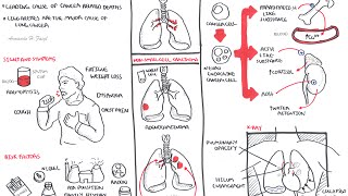 Lung Cancer  Overview [upl. by Arinaid732]