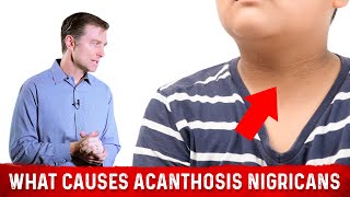 What Causes Acanthosis Nigricans Darkened Skin Folds – Dr Berg [upl. by Eseuqcaj]