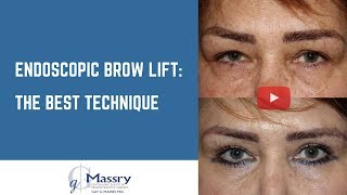 Endoscopic Brow Lift Video  Before amp After Brow Lift [upl. by Litch]