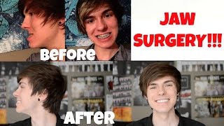 Jaw Surgery Experience Vlog  Surgery amp Recovery Day 1 [upl. by Valora]