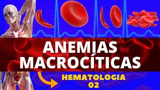 ANEMIAS MACROCÍTICAS  ANEMIA MEGALOBLÁSTICA E ANEMIA PERNICIOSA  HEMATOLOGIA [upl. by Helbona]