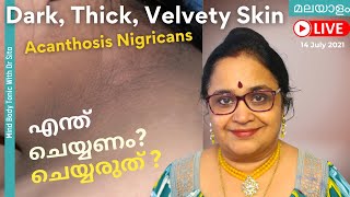 Acanthosis Nigricans  കറുത്ത നിറംപാടുകൾ  എന്തിനെ സൂചിപ്പിക്കുന്നു  മാറിപോകാൻ ചെയ്യേണ്ടത് [upl. by Lawler]