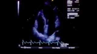 Echocardiography of the heart [upl. by Daren]