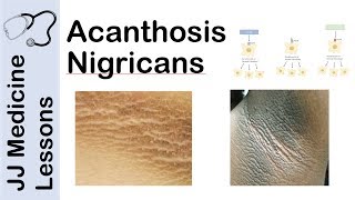 Acanthosis Nigricans  Risks Pathogenesis and Treatments [upl. by Beckie]