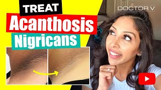 Doctor V  How To Treat Acanthosis Nigrican  Skin Of Colour  Brown Or Black Skin [upl. by Reidar626]