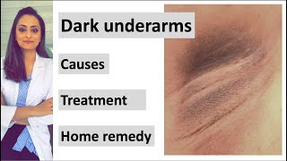 How to get rid of Dark underarms  causes treatment home remedy Dermatologist  Dr Aanchal [upl. by Stephanus]