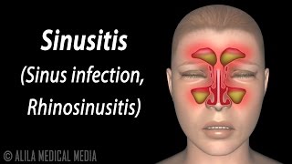 Fungal Sinusitis [upl. by Aienahs]